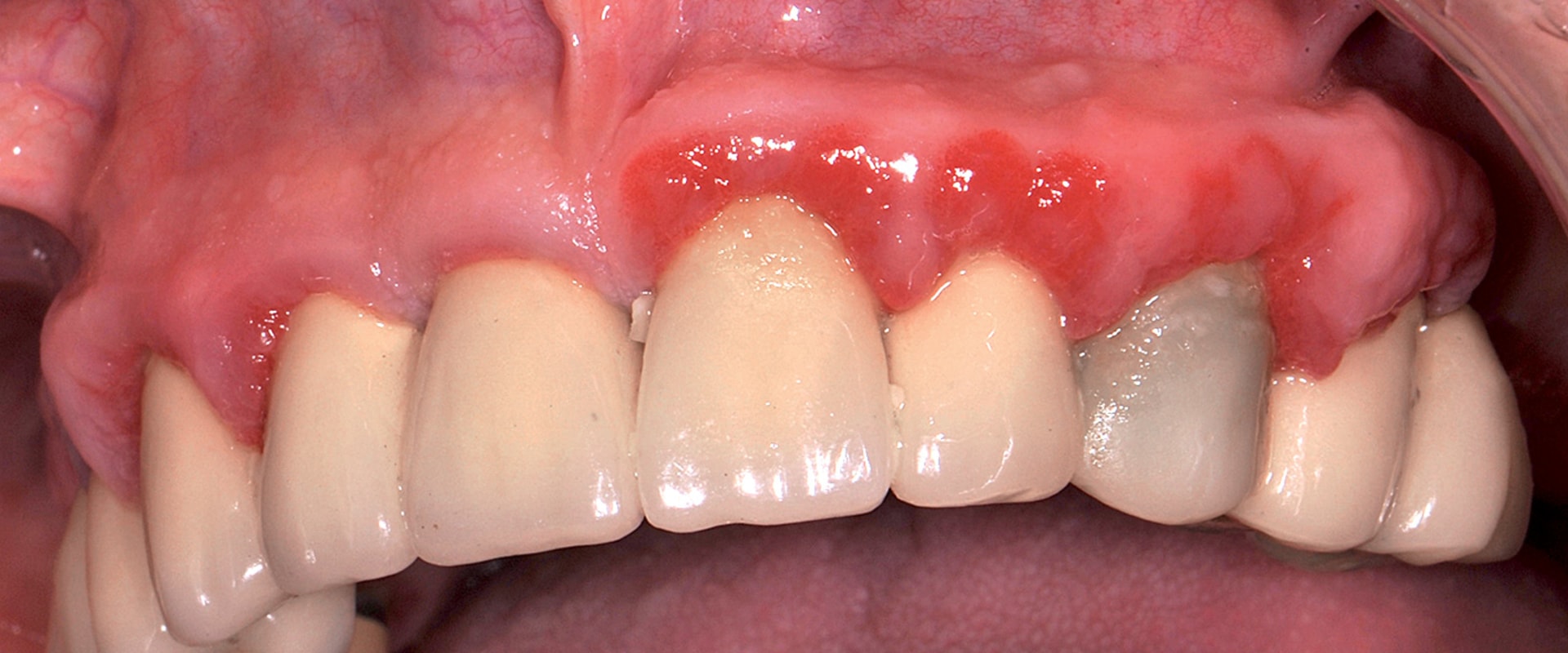 Lesione del nervo linguale: come riconoscerla e denunciare il dentista