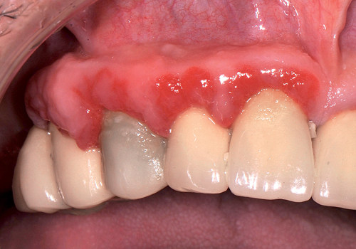 Lesione del nervo linguale: come riconoscerla e denunciare il dentista